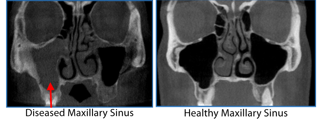 Healthy vs Diseased Maxillary Sinus