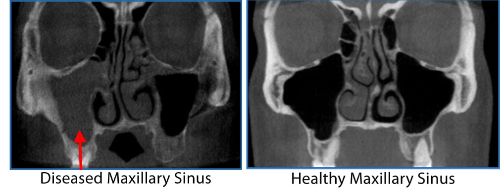 3-D Sinus Imaging - CT Scan of the Sinuses | NY Allergy & Sinus Centers