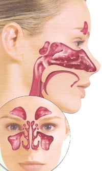 Metal allergy symptoms in mouth